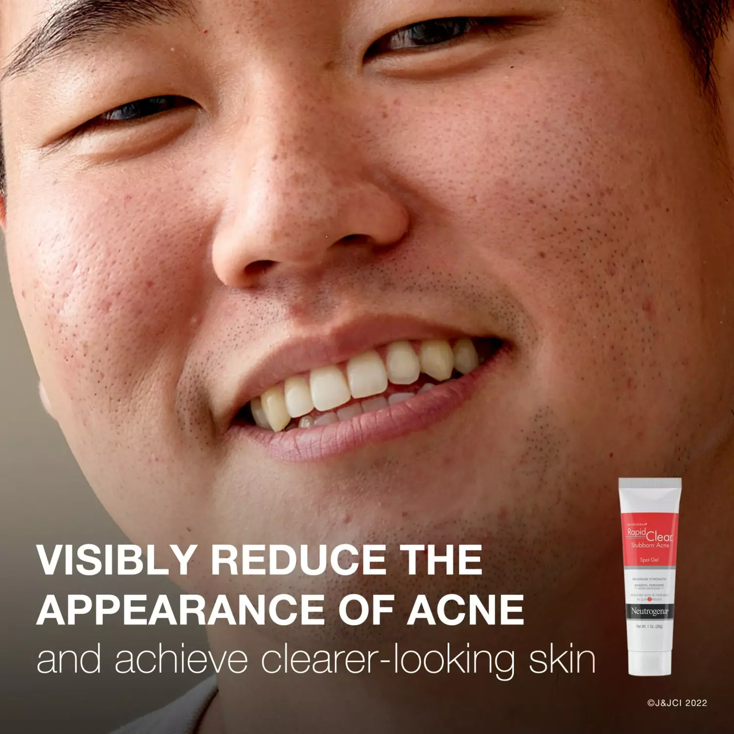 Neutrogena Rapid Clear Stubborn Acne Spot Gel