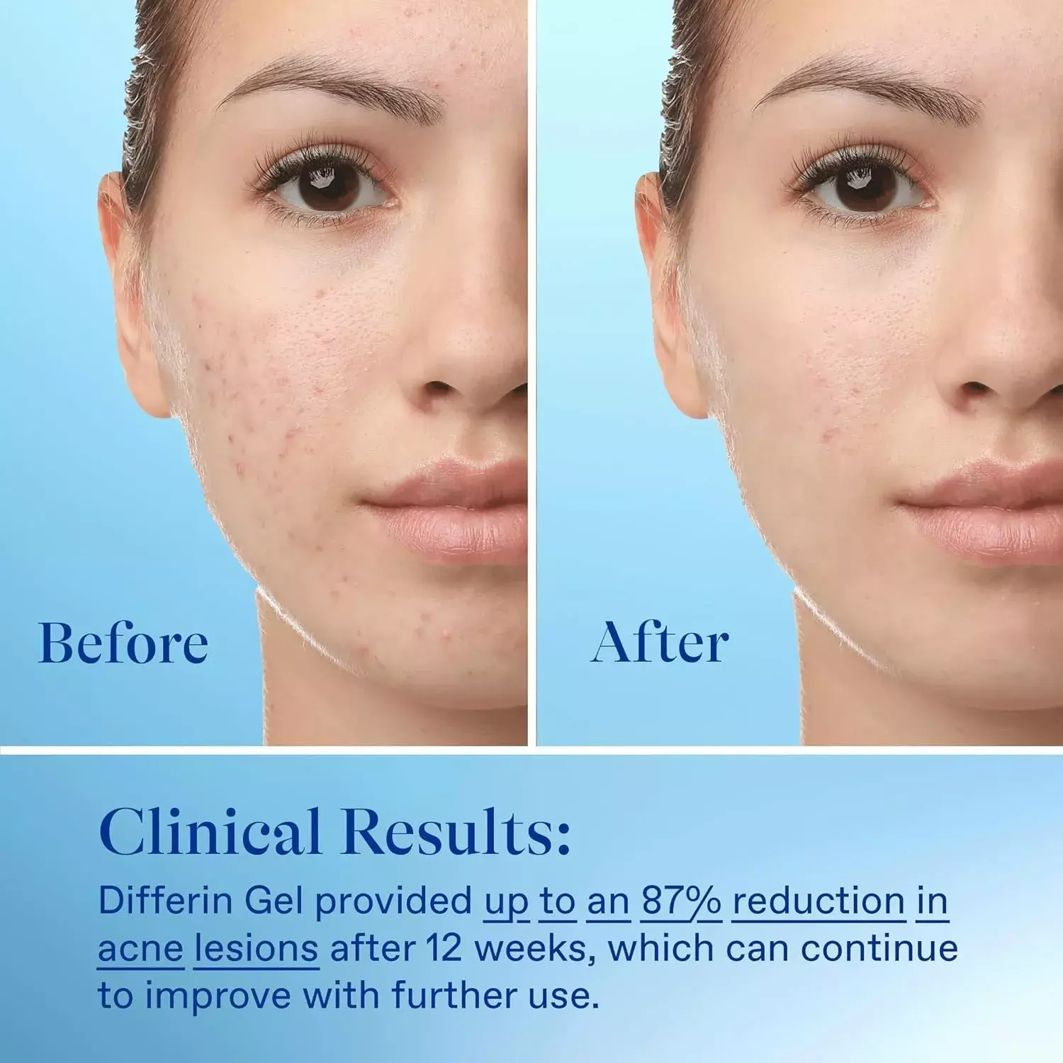 Differin Adapalene Gel 0.1% Acne Treatment 15G