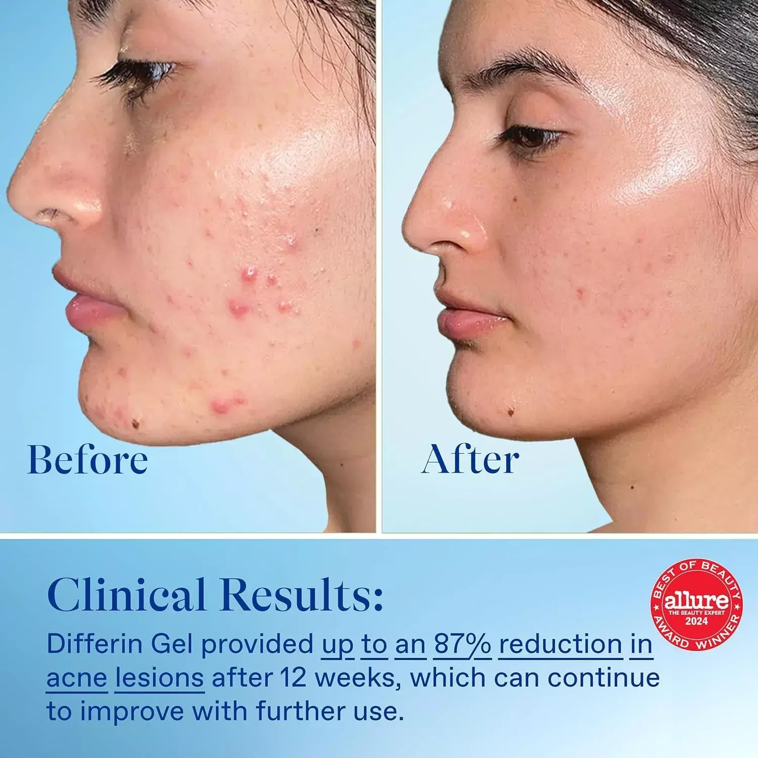 Differin Adapalene Gel 0.1% Acne Treatment PUMP 45g