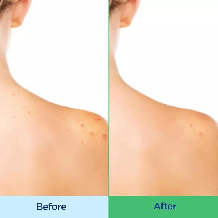 Differin Acne-Clearing Body Wash (295ml)(Exp-2027-04)