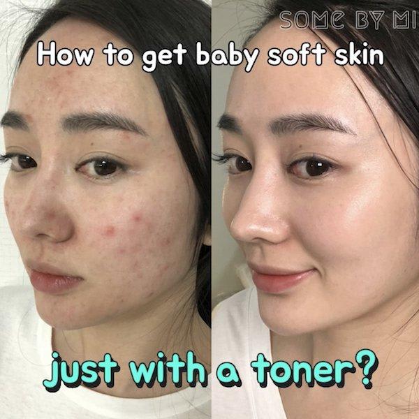 Some By Mi Miracle Toner and Miracle Cream