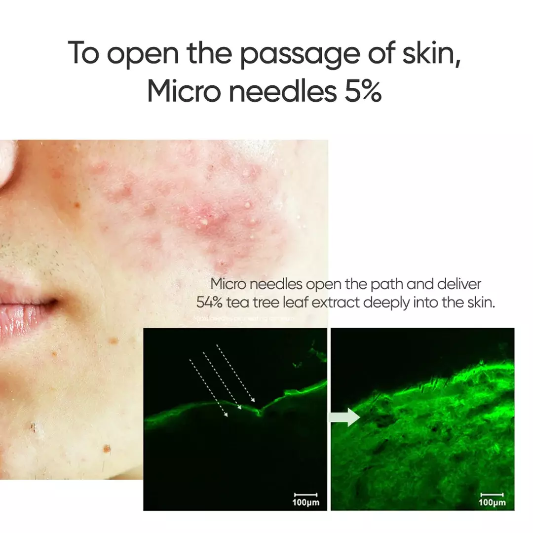 Commonlabs Vitamin E Micro Needle Spot Cream (10ml)
